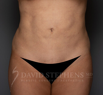 Abdominoplasty-Patient-19 | Before Body