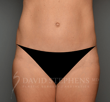 Abdominoplasty-Patient-20 | After Body