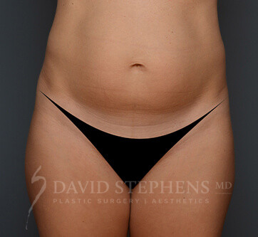 Abdominoplasty-Patient-20 | Before Body