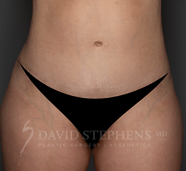 Abdominoplasty-Patient-21 | After Body