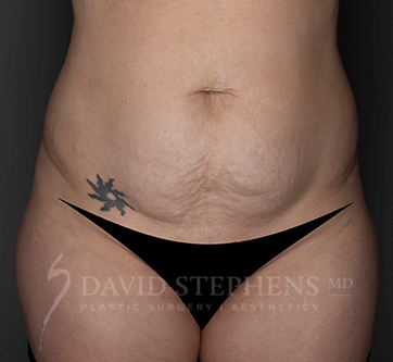 Abdominoplasty-Patient-21 | Before Body