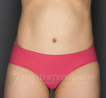 Abdominoplasty-Patient-22 | After Body