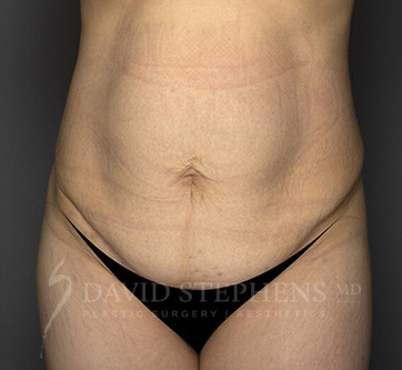 Abdominoplasty-Patient-22 | Before Body