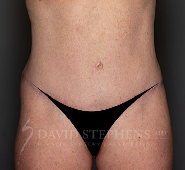 Abdominoplasty-Patient-23 | After Body