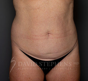 Abdominoplasty-Patient-23 | Before Body
