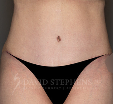 Abdominoplasty-Patient-25 | After Body