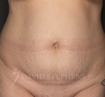 Abdominoplasty-Patient-25 | Before Body