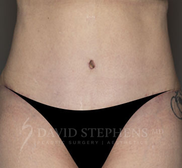 Abdominoplasty-Patient-26 | After Body