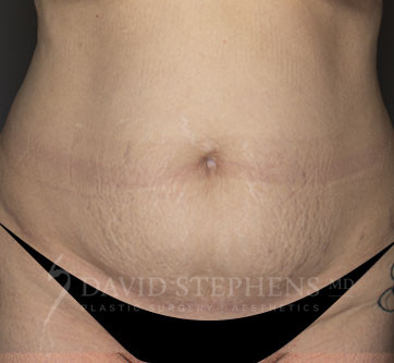 Abdominoplasty-Patient-26 | Before Body