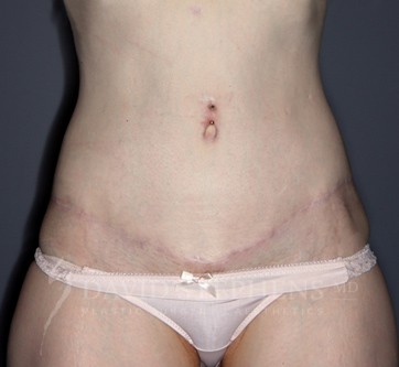 Abdominoplasty-Patient-27 | After Body