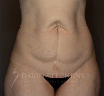 Abdominoplasty-Patient-27 | Before Body