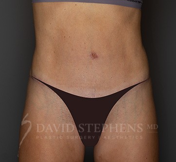 Abdominoplasty-Patient-28 | After Body