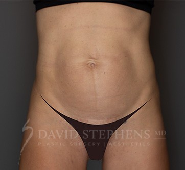 Abdominoplasty-Patient-28 | Before Body