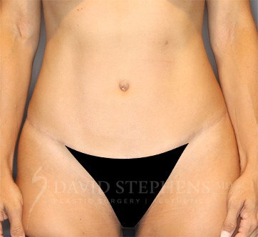 Abdominoplasty-Patient-30 | After Body