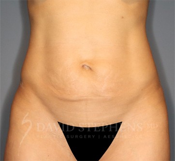 Abdominoplasty-Patient-30 | Before Body
