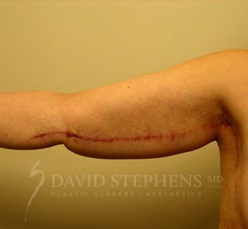 Arm-Lift-Patient-01 | After Body