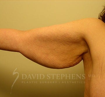 Arm-Lift-Patient-01 | Before Body