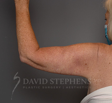 Arm-Lift-Patient-02 | After Body