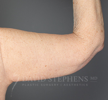 Arm-Lift-Patient-03 | After Body