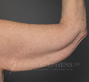 Arm-Lift-Patient-03 | Before Body