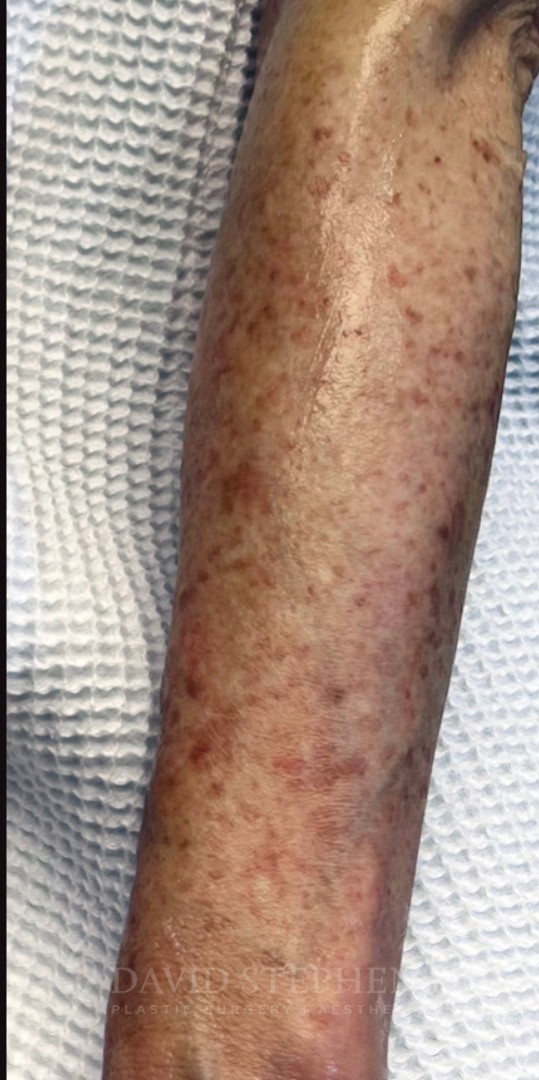 BBL-Hero-Arm-Patient-02 | After BBL Hero Non Surgical Body