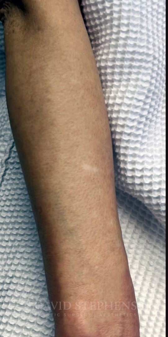 BBL-Hero-Arm-Patient-02 | Before BBL Hero Non Surgical Body