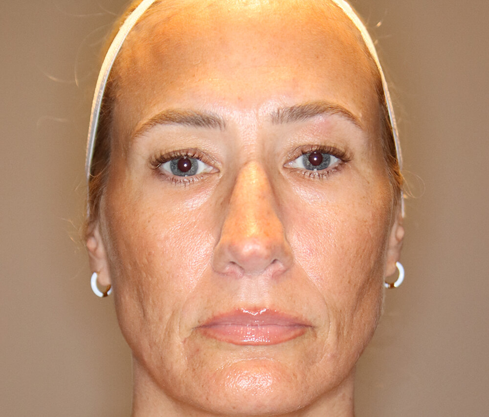 Case--7601 | Before Face
