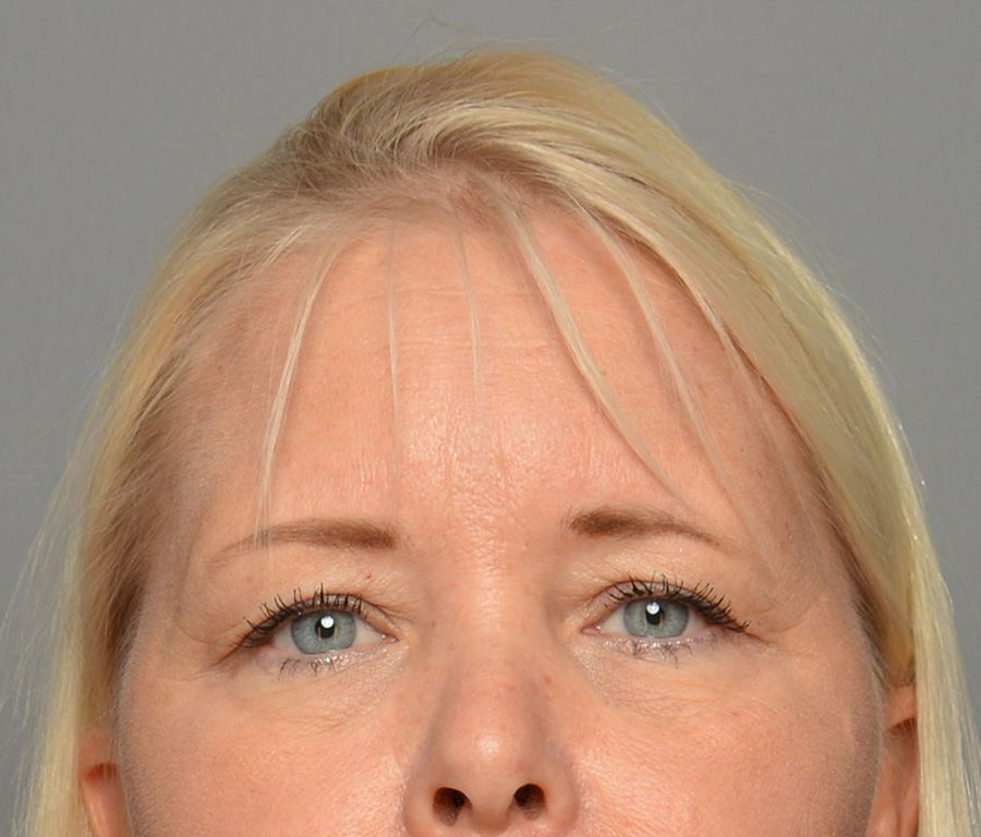 Case--3879 | Before Surgical Face