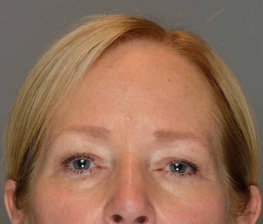 Case--2869 | Before Surgical Face