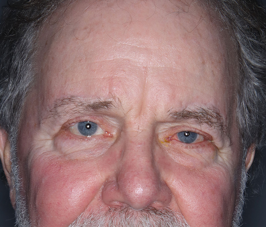 Case--4785 | Before Surgical Face