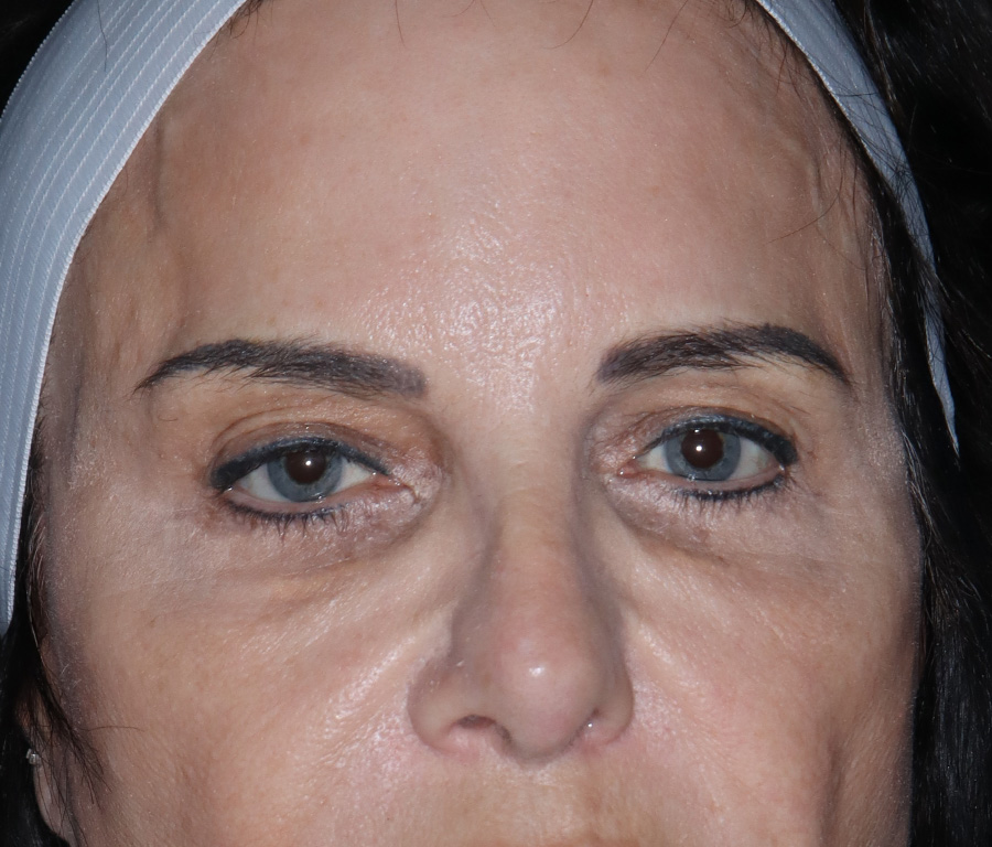 Case--1340 | Before Surgical Face
