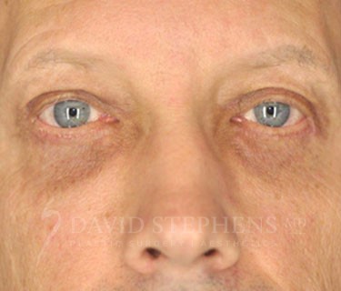 Blepharoplasty-Patient-01 | After Blepharoplasty