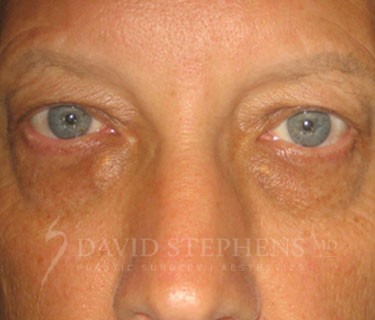 Blepharoplasty-Patient-01 | Before Blepharoplasty