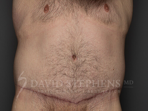 Body-Lift-for-Men-Patient-02 | After Body Lift for Men