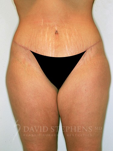 Body-Lift-Patient-03 | After Body Lift