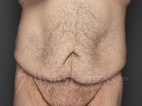 Cosmetic Surgery for Men - Actual Patient Results - Before - 4