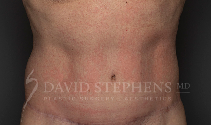 Cosmetic Surgery for Men - Actual Patient Results - After - 3