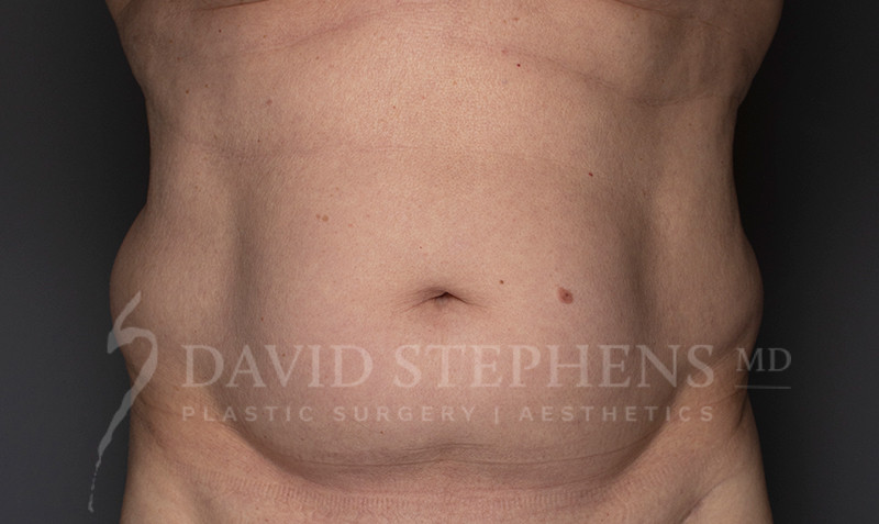 Cosmetic Surgery for Men - Actual Patient Results - Before - 3
