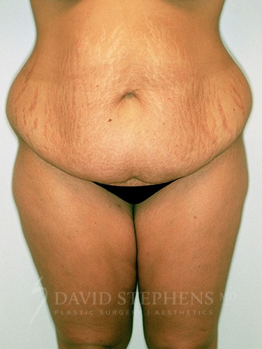 Body-Lift-Patient-03 | Before Body