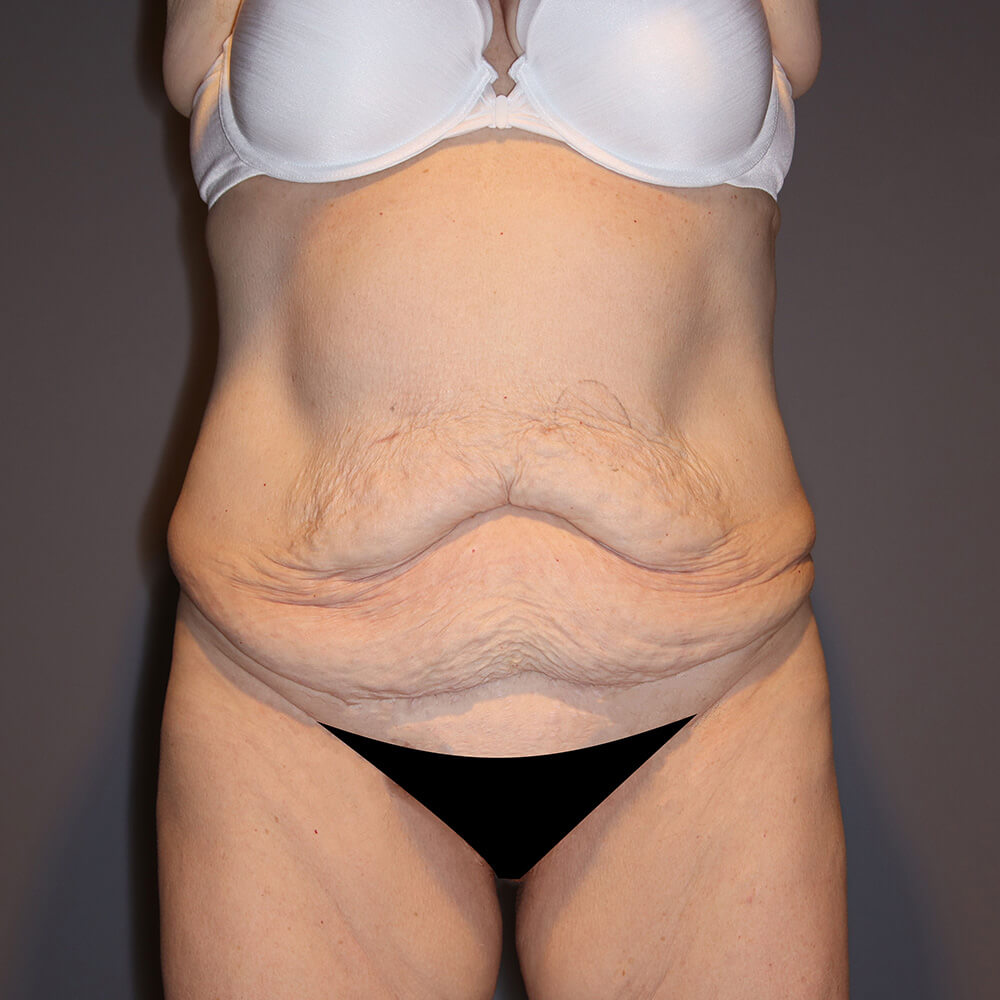 Body-Lift-Patient-05 | Before Body Lift