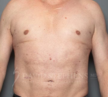 Bodytite-Patient-06 | After Body