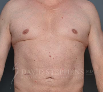 Bodytite-Patient-06 | Before Body