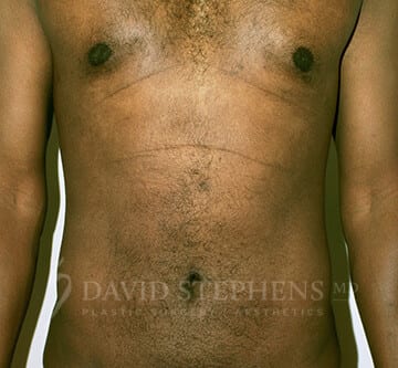 Bodytite-Patient-07 | After Body