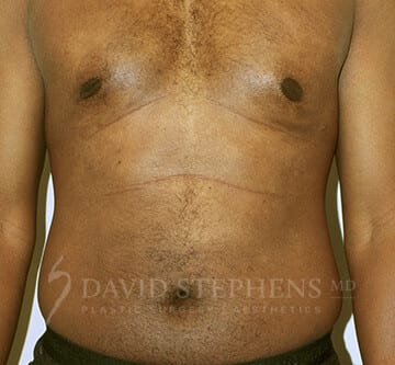 Bodytite-Patient-07 | Before Body