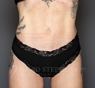 Bodytite-Patient-08 | After Body