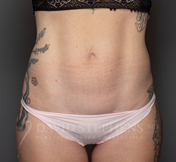 Bodytite-Patient-08 | Before Body