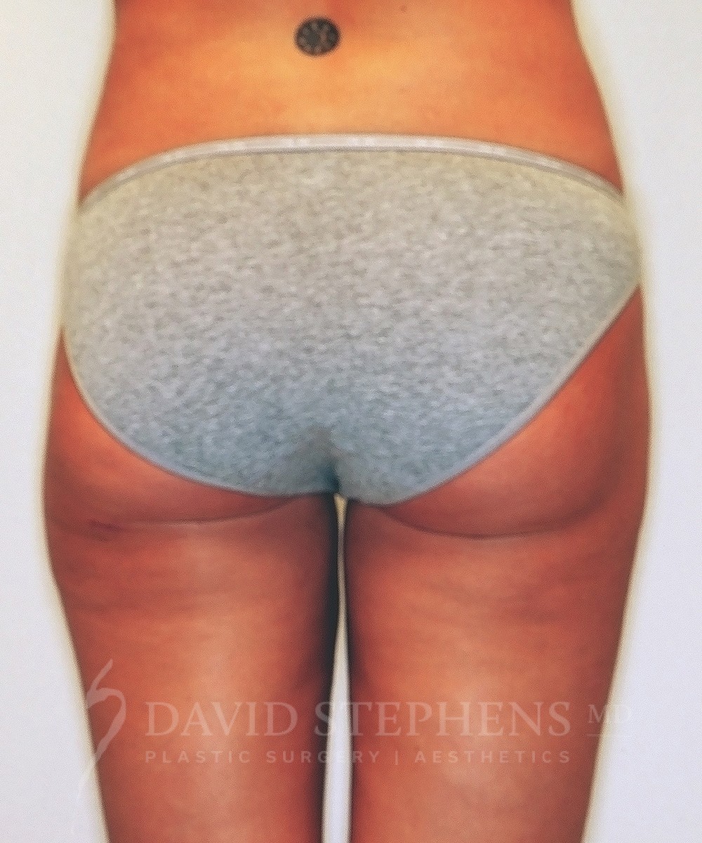 Bodytite-Patient-09 | After Body