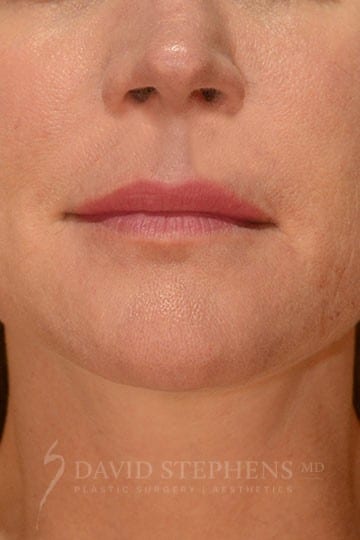 Facial Rejuvenation - Actual Patient Results - After - 3