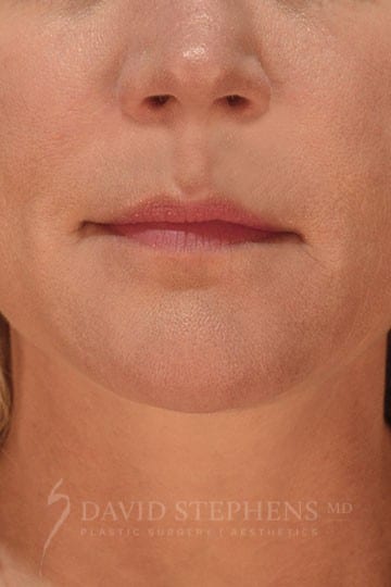Facial Rejuvenation - Actual Patient Results - Before - 3