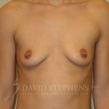 Breast-Augmentation-Patient-36 | Before Breast